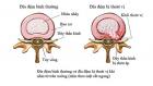 Rách Bao Xơ Đĩa Đệm Nguyên Nhân Và Cách Chữa 