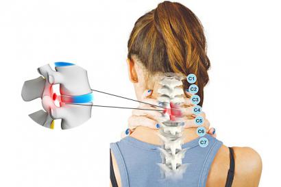 Tại Sao Lại Đau Cột Sống Cổ? Nguyễn Nhân Và Cách Chữa