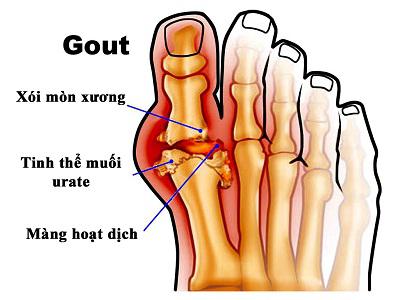 Bệnh Gout điều trị nhanh và hiệu quả