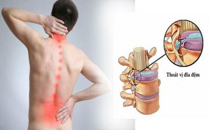 Nguyên Nhân Dấu Hiệu Và Cách Điều Trị Bệnh Vỡ Đốt Sống