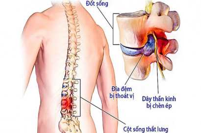 Điều trị thoát vị đĩa đệm: Ứng dụng công nghệ khoa học tiên tiến vào điều trị