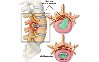 Nguyên Nhân Và Cách Điều Trị Bệnh Thoát Vị Đĩa Đệm Hiệu Quả