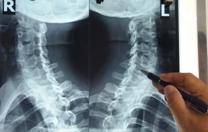 Những biến chứng thường gặp của bệnh thoái hóa cột sống cổ